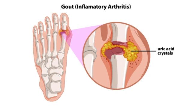 Research: CBD in the Treatment of Gout (Inflammatory Arthritis)